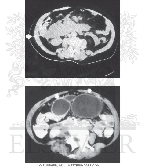 Watermarked preview of unlabeled image: Complications of Acute Pancreatitis: CT Images of Necrosis and Pseudocysts