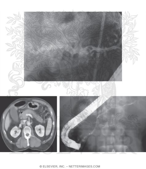 Watermarked preview of unlabeled image: Chronic and Autoimmune Pancreatitis