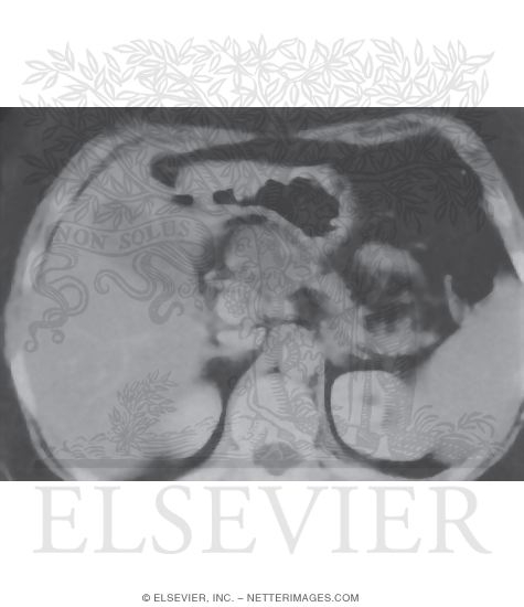Watermarked preview of unlabeled image: Cystic Tumors: Serous Cystadenoma of the Pancreas