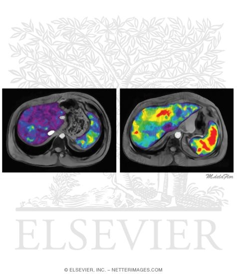 Watermarked preview of unlabeled image: Magnetic Resonance Elastography to Stage Hepatic Fibrosis