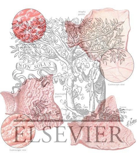 Watermarked preview of labeled image: Gastritis