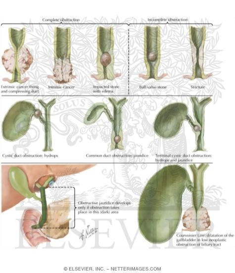 Watermarked preview of labeled image: Extrahepatic Biliary Obstruction I - Mechanism