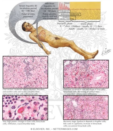 Watermarked preview of labeled image: Viral Hepatitis I - Acute Form