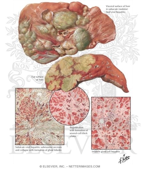 Watermarked preview of labeled image: Viral Hepatitis III - Subacute Fatal Form