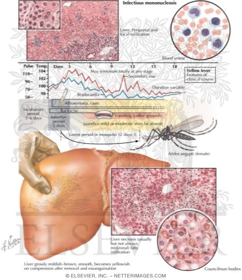 Watermarked preview of labeled image: Infectious Mononucleosis, Yellow Fever