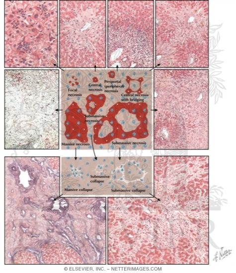 Watermarked preview of labeled image: Hepatic Necrosis