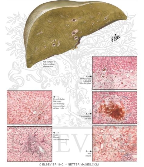 Watermarked preview of labeled image: Extrahepatic Biliary Obstruction II - Stages