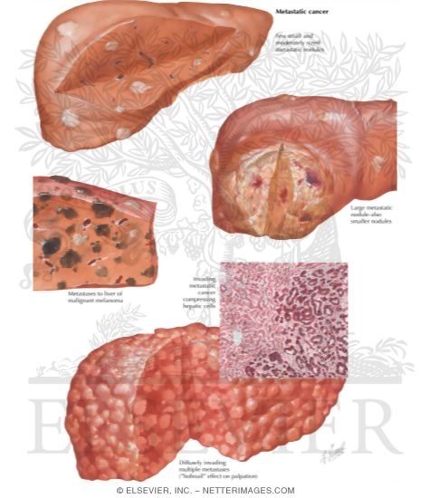 Watermarked preview of labeled image: Tumors V - Secondary, Metastatic