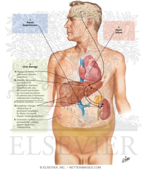 Ascites - Pathogenesis