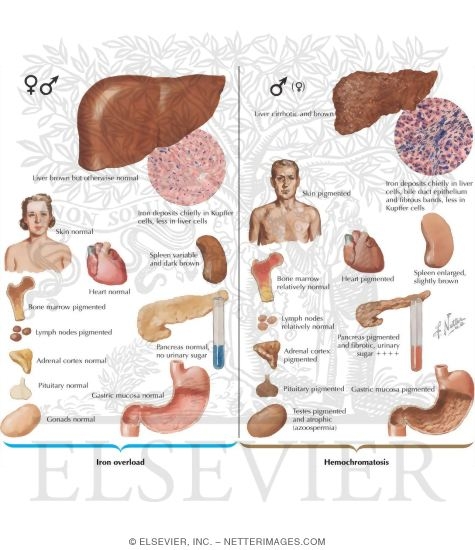 Watermarked preview of labeled image: Hemosiderosis, Hemochromatosis: Normal Iron Metabolism