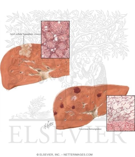 Watermarked preview of labeled image: Tumors I - Hamartomas, Hemangiomas