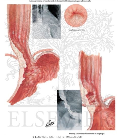 Watermarked preview of labeled image: Malignant Tumors: Lower End of Esophagus