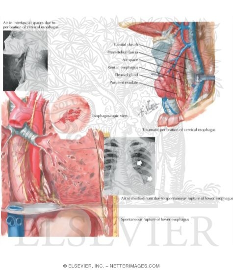 Watermarked preview of unlabeled image: Esophageal Rupture and Perforation