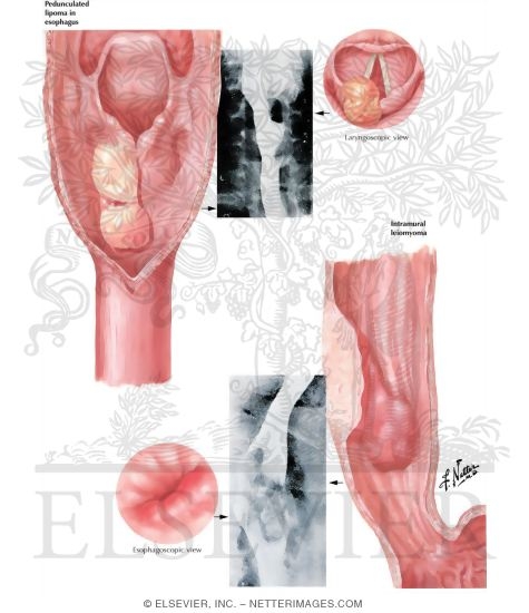 Watermarked preview of unlabeled image: Benign Neoplasms