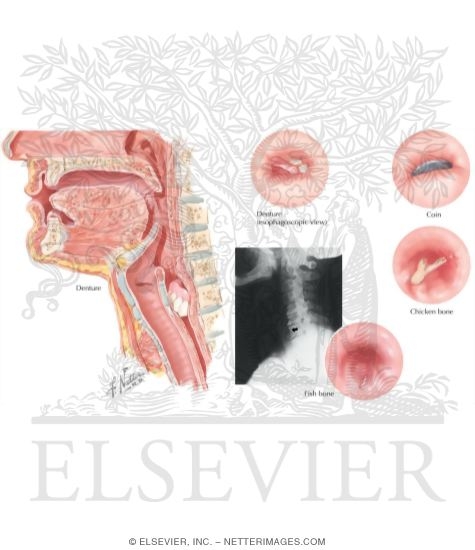 Watermarked preview of unlabeled image: Foreign Bodies In the Esophagus