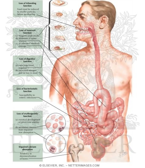 Watermarked preview of unlabeled image: Effects of Total Gastrectomy