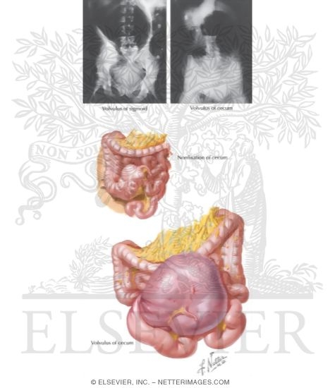 Volvulus of the Cecum