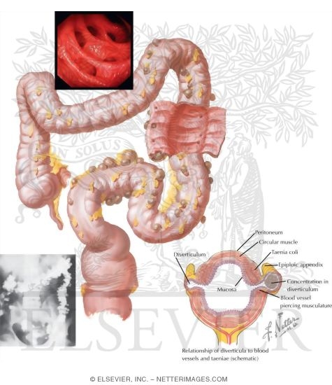 Watermarked preview of labeled image: Diverticulosis   