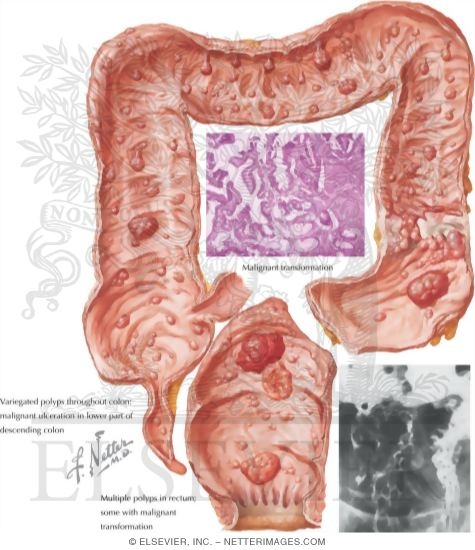 Watermarked preview of labeled image: Familial Polyposis of Large Intestine