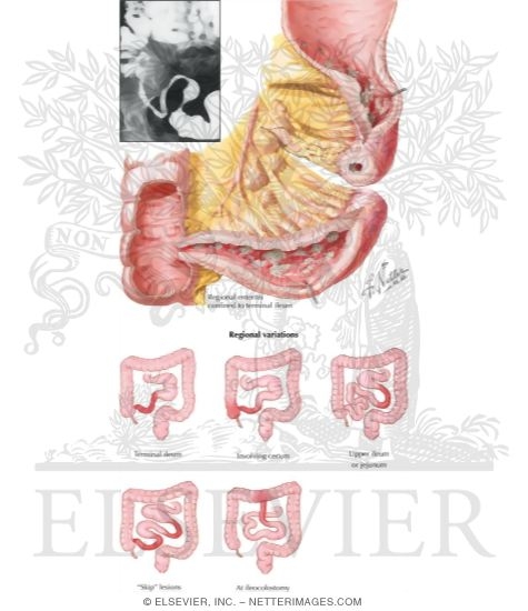 Watermarked preview of labeled image: Regional Enteritis (Crohn Disease)