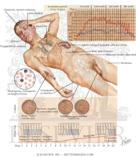 Diagnosis of Typhoid Fever