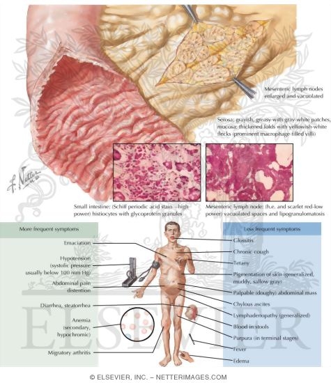 Watermarked preview of labeled image: Intestinal Lipodystrophy