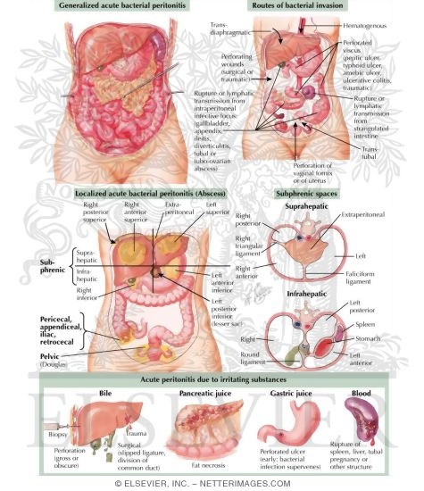 Watermarked preview of labeled image: Acute Peritonitis