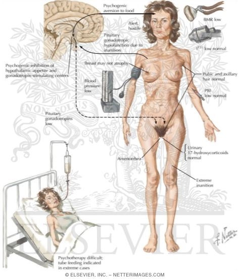 Watermarked preview of labeled image: Anorexia Nervosa: A Psychoneurotic Disorder