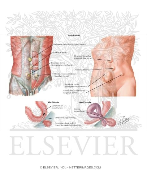 Abdominal Wall: Ventral Hernias