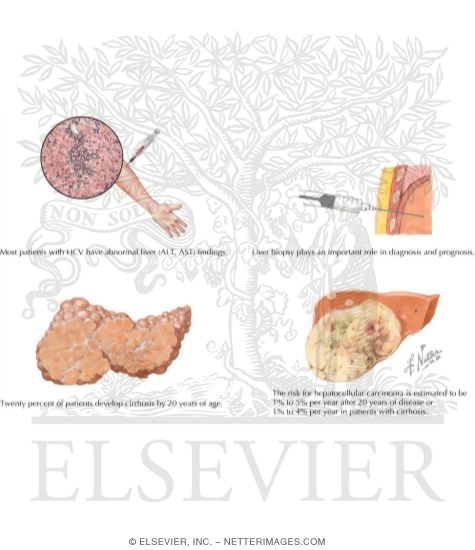 Watermarked preview of labeled image: Clinical Picture of Hepatitis C Infection