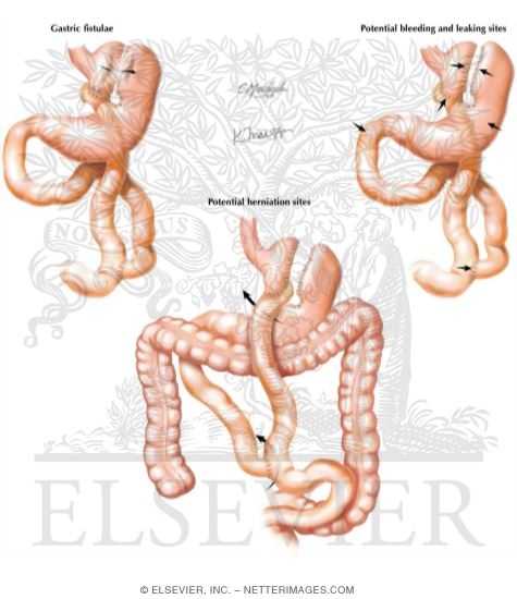 Watermarked preview of unlabeled image: Complications of Bariatric Surgery