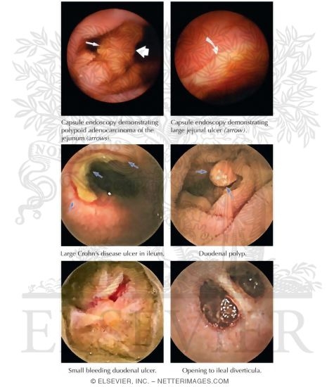 Watermarked preview of unlabeled image: Wireless Capsule Endoscopy