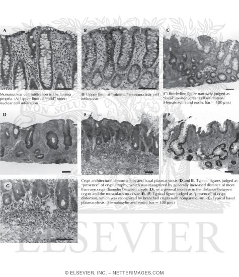 Ulcerative Colitis: Histologic Diagnosis and Dysplasia