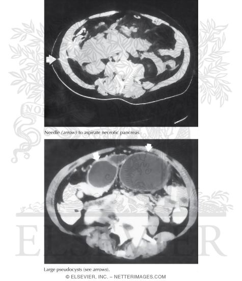 Complications of Acute Pancreatitis: CT Images of Necrosis and Pseudocysts
