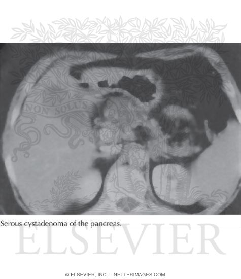 Watermarked preview of unlabeled image: Cystic Tumors: Serous Cystadenoma of the Pancreas