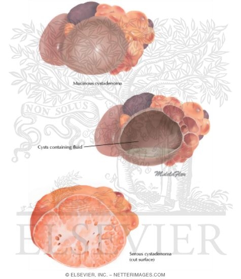 Watermarked preview of unlabeled image: Cystic Tumors: Cystadenoma and Cystadenocarcinoma