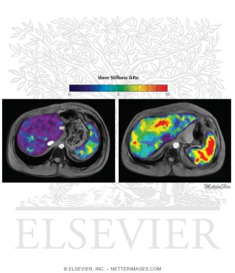 Watermarked preview of unlabeled image: Magnetic Resonance Elastography to Stage Hepatic Fibrosis