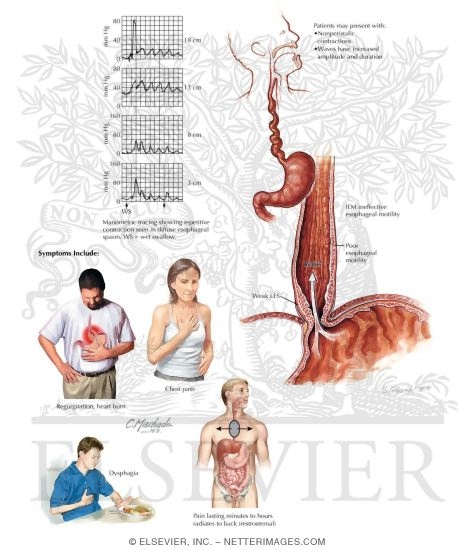 Watermarked preview of unlabeled image: Esophageal Spasm Syndromes