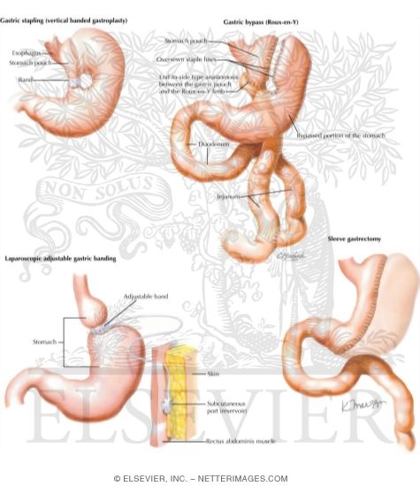 Watermarked preview of labeled image: Surgical Treatment Options for Obesity