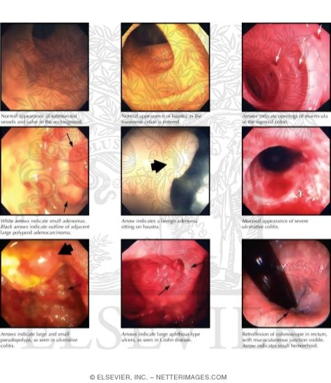 Watermarked preview of unlabeled image: Anoscopic, Sigmoidoscopic, and Colonoscopic Views of Normal Intestinal Structures and Various Lesions