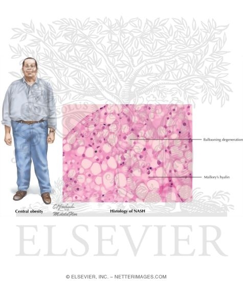 Nonalcoholic Steatohepatitis