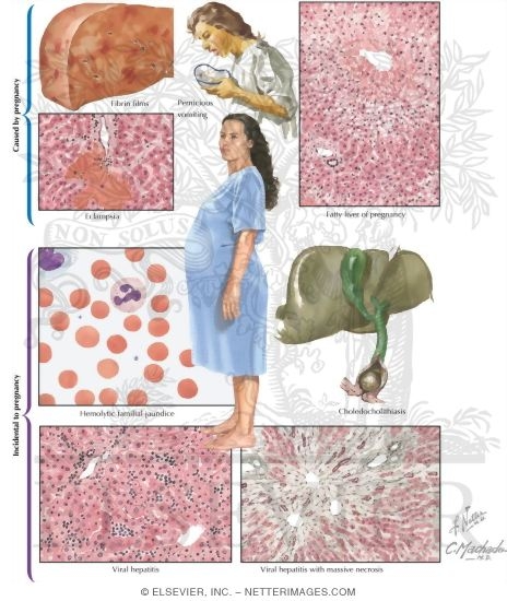 Watermarked preview of unlabeled image: Liver Disease In Pregnancy