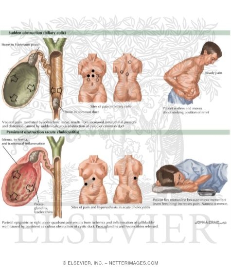 Watermarked preview of labeled image: Mechanisms of Biliary Pain