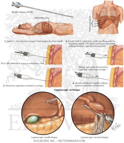Liver Biopsy