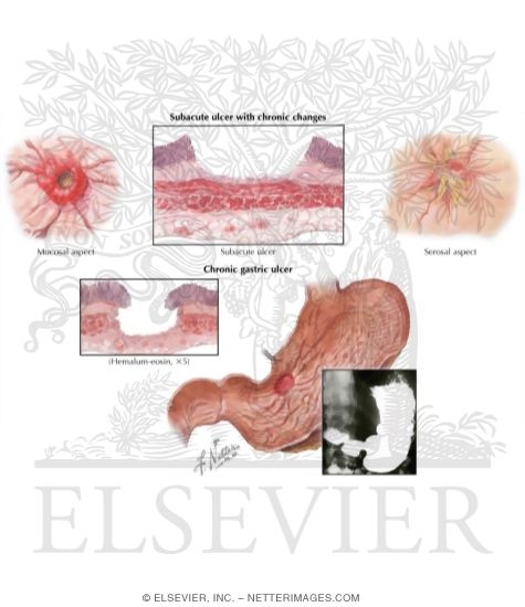 Watermarked preview of unlabeled image: Subacute and Chronic Gastric Ulcers