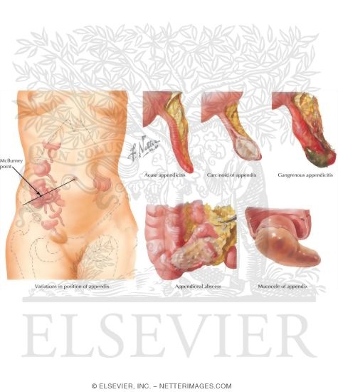 Watermarked preview of unlabeled image: Diseases of the Appendix: Inflammation, Mucucele, and Tumors