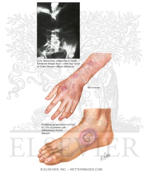 Ulcerative Colitis: Extraintestinal Manifestations and Complications