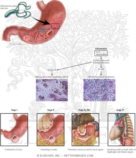 Gastric Lymphoma and MALT