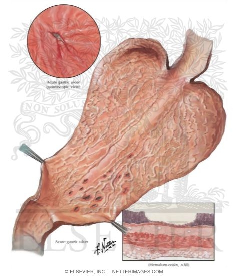 Watermarked preview of labeled image: Peptic Ulcer I - Acute Gastric Ulcer