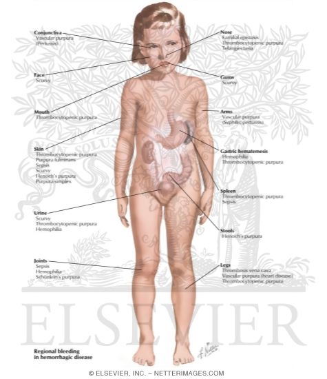 Watermarked preview of labeled image: Hemorrhagic Problems In Infants and Children